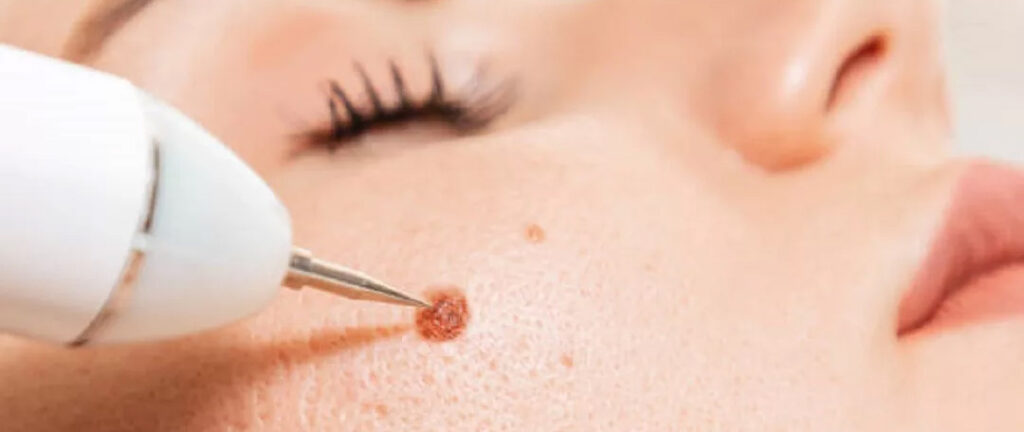 Lesion Removal in Calgary